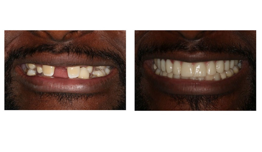 Provisional (Temporary) Crowns